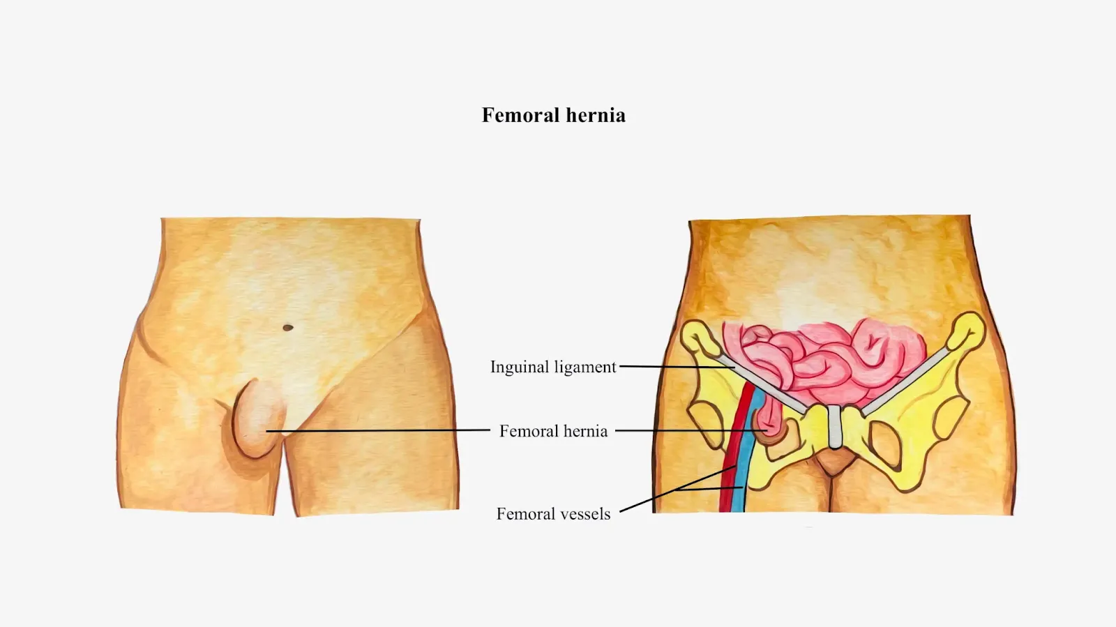 Hernia Femoralis